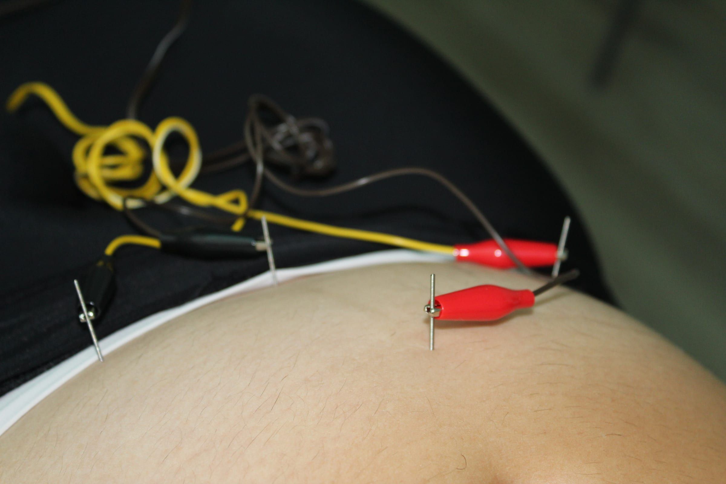Electroacupuntura en el abdomen: agujas conectadas con pinzas a los cables del aparato